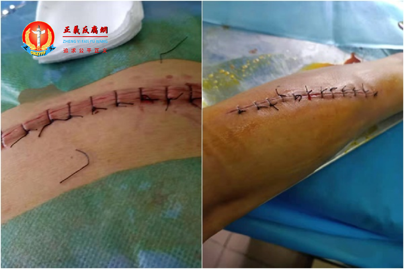 陆忠友腹部(左)与手腕的伤口。.png 陆忠友腹部(左)与手腕的伤口。.png