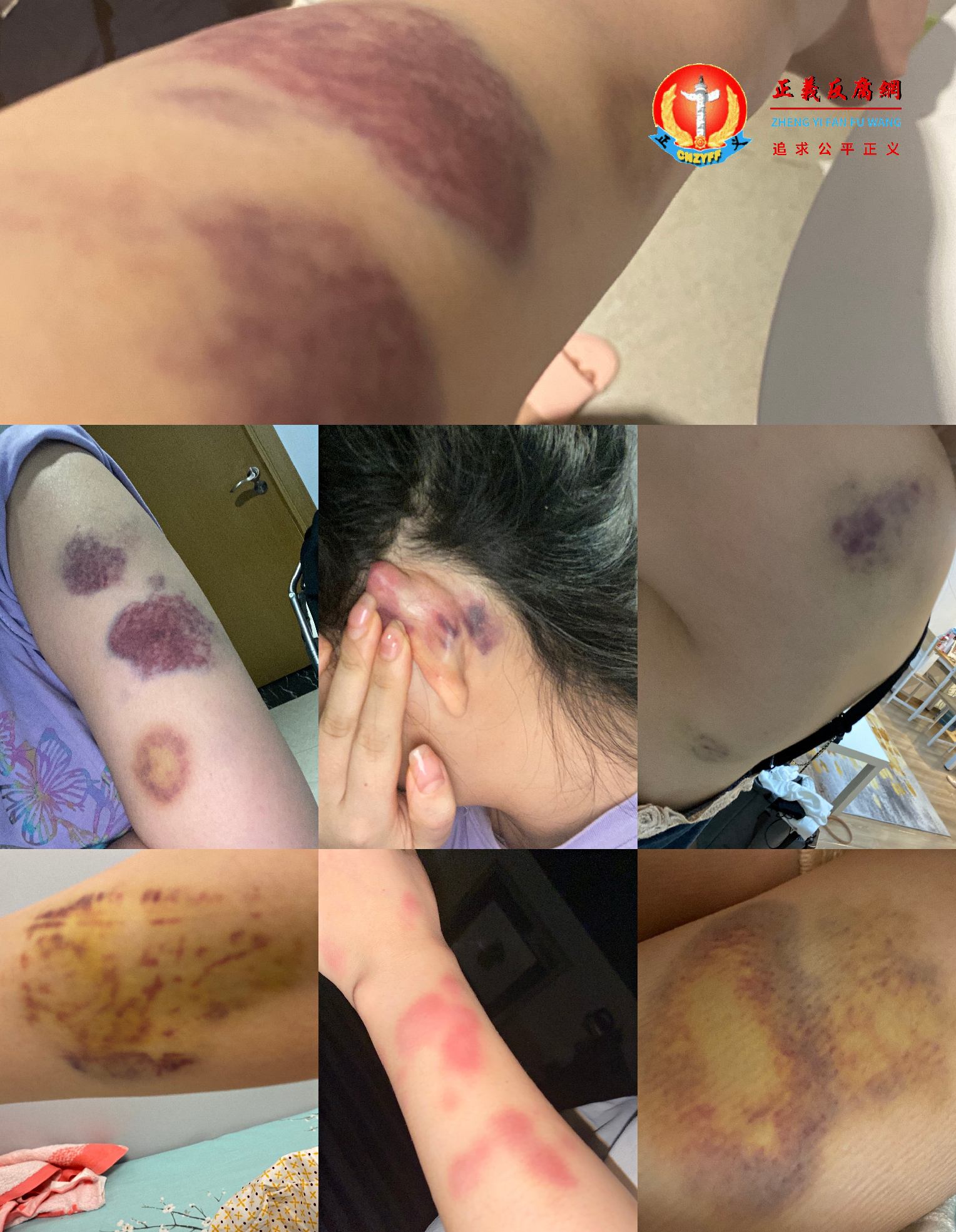 爆料女性小雅po出遭雷姓男子长期殴打的照片。.png 爆料女性小雅po出遭雷姓男子长期殴打的照片。.png