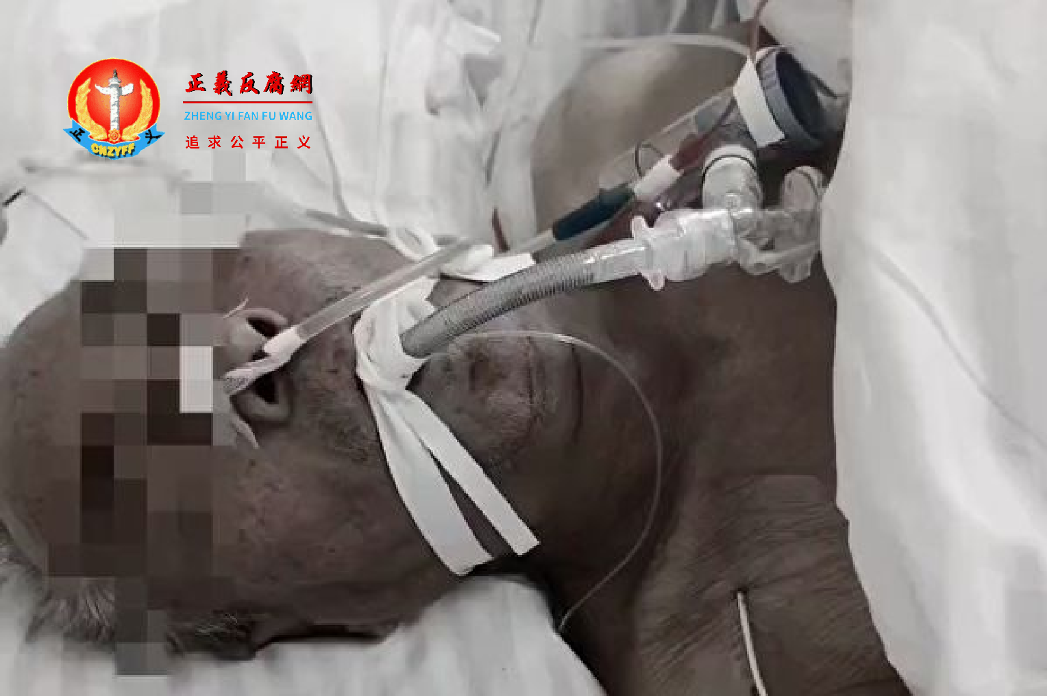 一吉林市居民表示,她患有小脑萎缩症的父亲日前被强行拉去方舱医院隔离期间,不慎跌倒后长达7个小时都无人救助,结果因错过抢救时机而死亡。.png 一吉林市居民表示,她患有小脑萎缩症的父亲日前被强行拉去方舱医院隔离期间,不慎跌倒后长达7个小时都无人救助,结果因错过抢救时机而死亡。.png