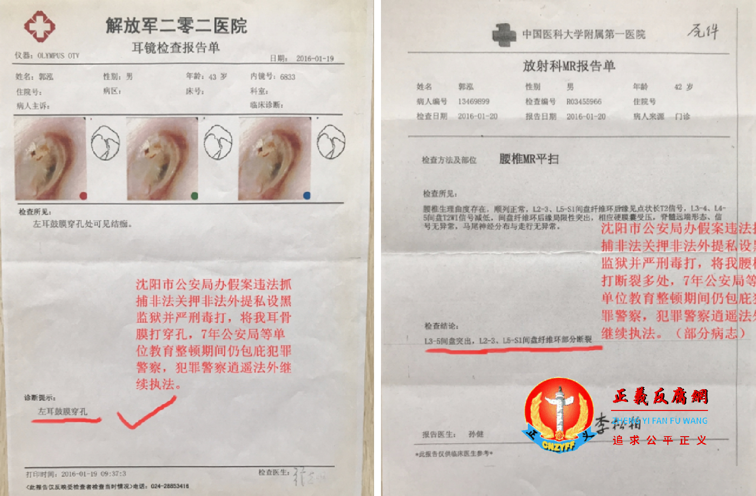 郭泓被毒打致左耳鼓膜穿孔,腰椎多处断裂。.png 郭泓被毒打致左耳鼓膜穿孔,腰椎多处断裂。.png